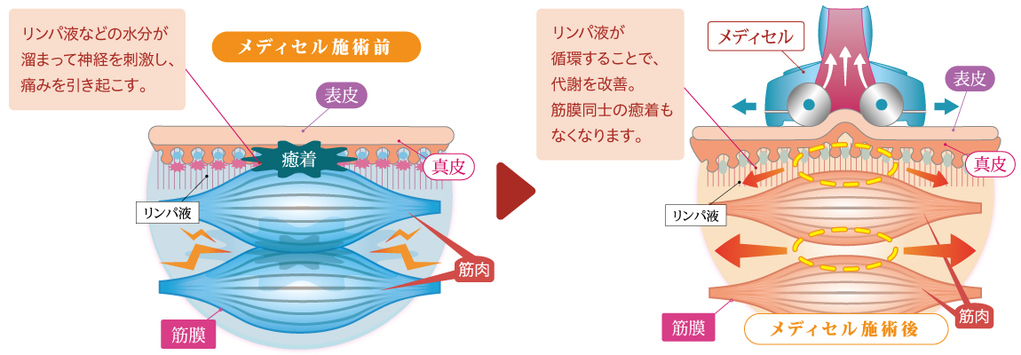 メディセル（筋膜療法）